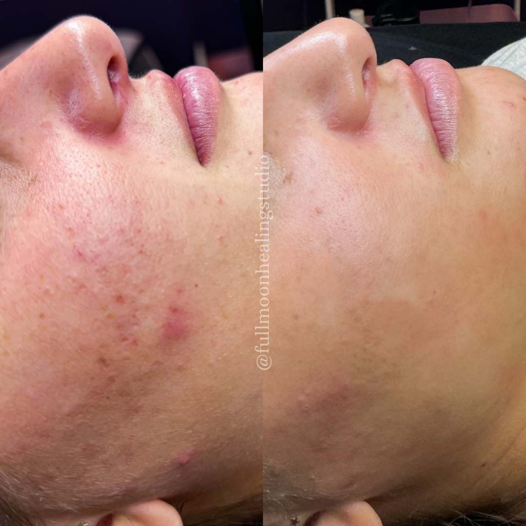 Results from Facial Treatments + Skincare
