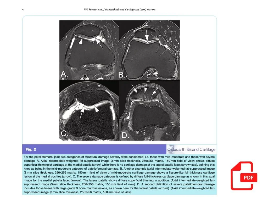 Do rates of femorotibial cartilage loss in Kellgren-Lawrence 2 and 3 kneesdiffer between those with mild-moderate vs. severe patellofemoralstructural damage?