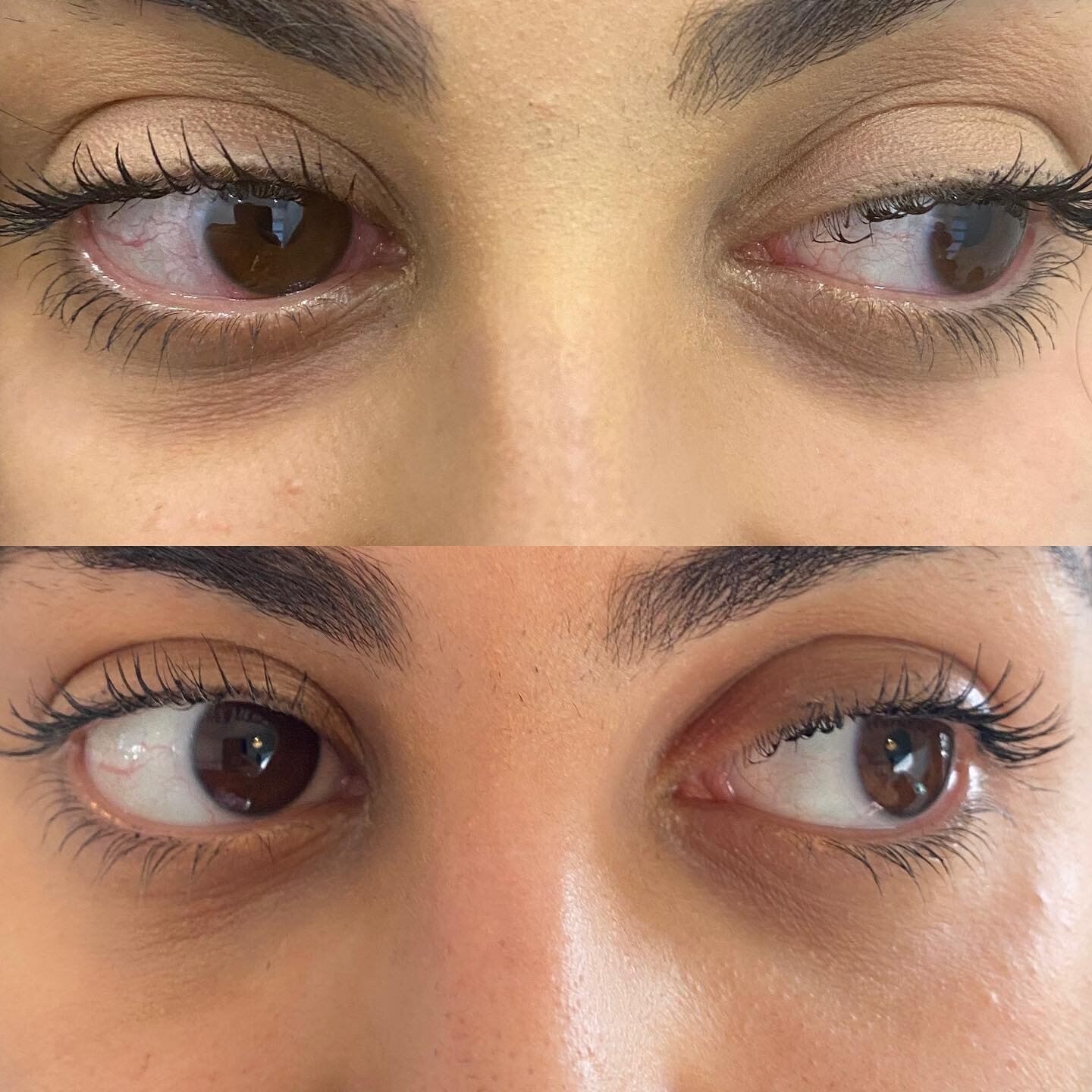TEAR TROUGH FILLERS!
Before and after 😍! 
This type of treatment is best for those clients with hollowness under their eyes. Hollow under eyes can cause the appearance of dark circles which can be corrected using dermal fillers
.
.
Not everybody is 