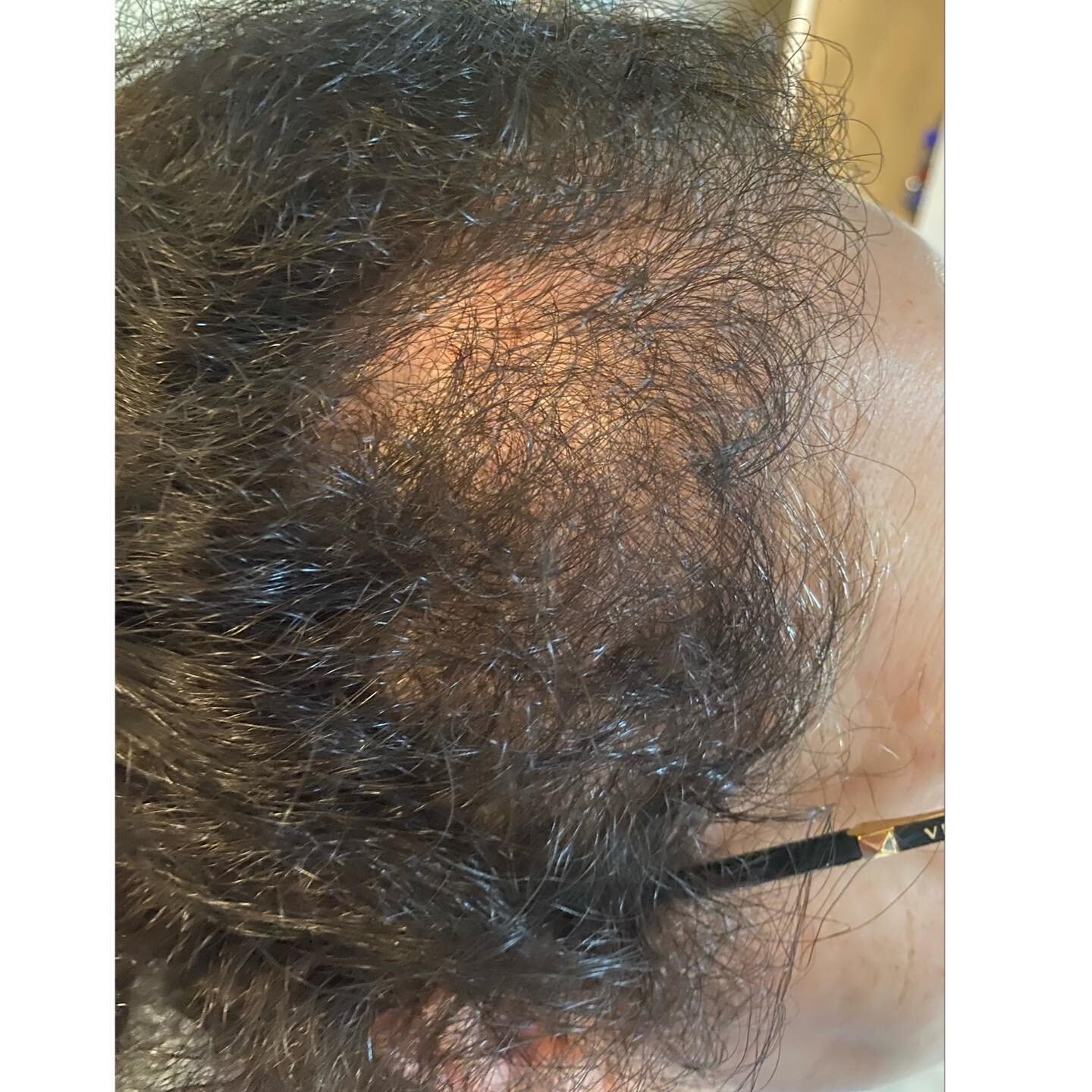 PRP for hair restoration! This client had three treatments 4 weeks apart and we are planning to do about two more! Take a look at her before and after pictures! #goodhairday 
.
#gotox #botox #dysport #goodbotox #anniversary #naturalresults #giveaway 