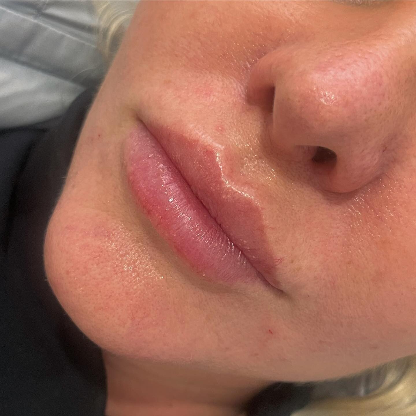 Half syringe top up for this client! ❤️ Beautiful and natural plump 😍 
.
.
#gotox #yourgotobotox #botox #dysport #goodbotox #naturalresults  #wrinklefree  #lipfillers #gotoxbotox #wrinkleprevention #lips #foreheadlines #frownline #botoxtreatment #be