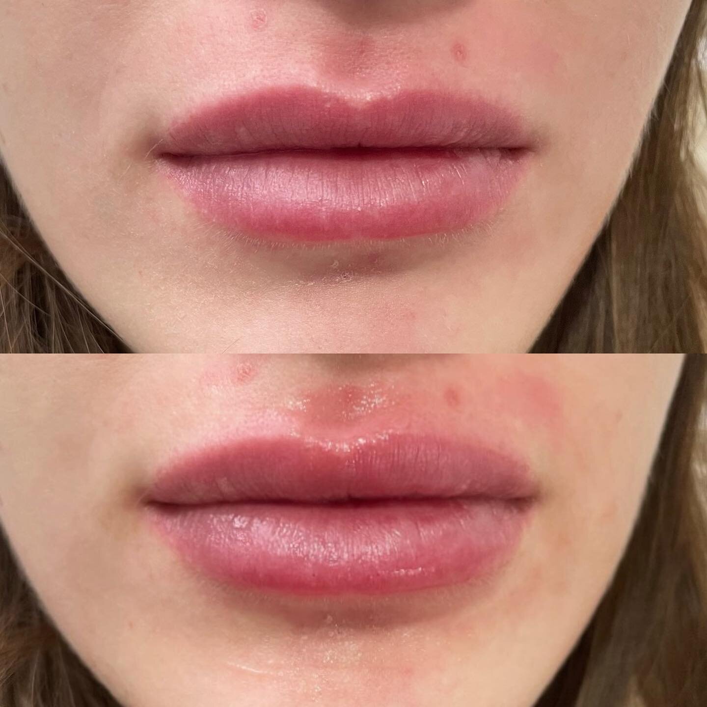 This client was looking to fix some asymmetry after having her lips dissolved from a previous injector. We helped shape and even things out just using half a syringe! 👄 
.
.
#gotox #yourgotobotox #botox #dysport #goodbotox #naturalresults  #wrinklef