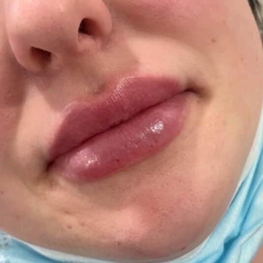 Half syringe top up! This client has been coming to me for a while now. We have progressively built up her shape and her volume one session at a time👄 
.
.
#gotox #yourgotobotox #botox #dysport #goodbotox #naturalresults  #wrinklefree  #lipfillers #