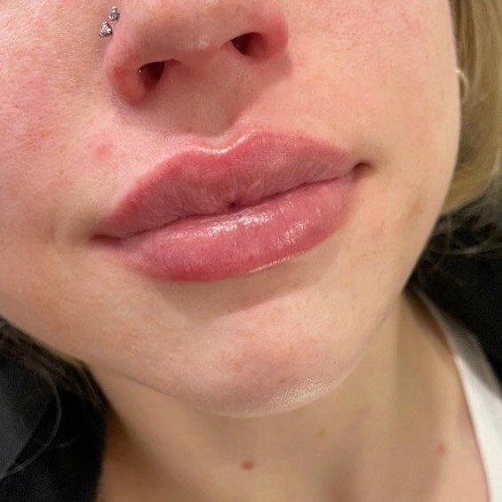 First time client! Able to achieve this beautiful shape with a half syringe 😍 
.
.
#gotox #yourgotobotox #botox #dysport #goodbotox #naturalresults  #wrinklefree  #lipfillers #gotoxbotox #wrinkleprevention #lips #foreheadlines #frownline #botoxtreat