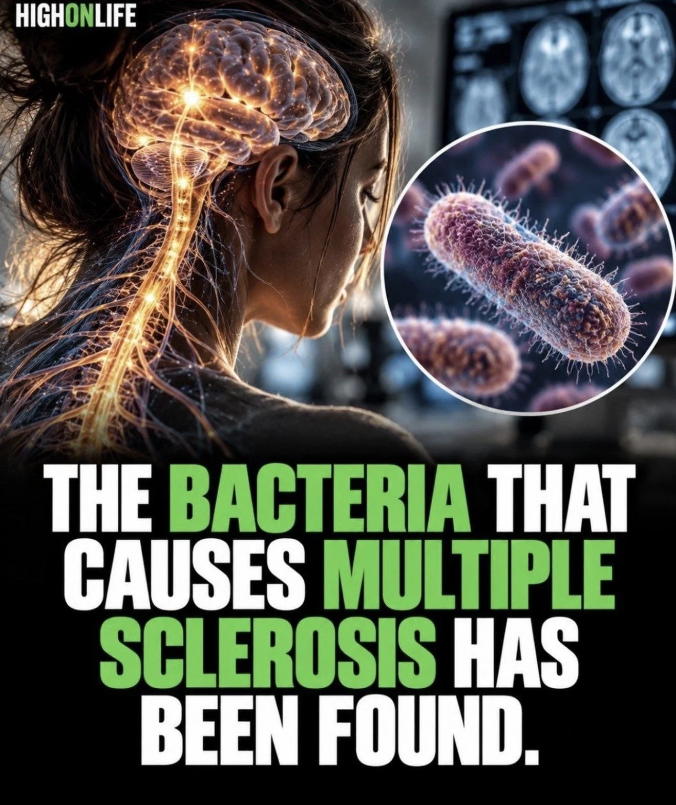 The Bacteria That Causes Multiple Sclerosis Has Been Found.