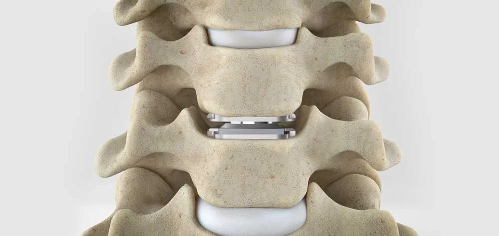 ACDF vs. Cervical Disc Replacement: Which Is Right for You?