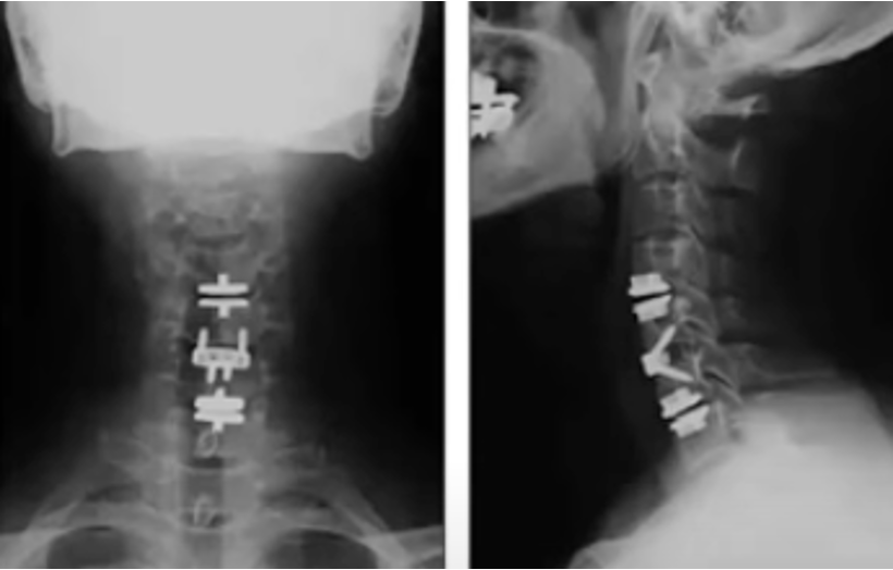 cervical hybrid, disc replacement, arthroplasty, fusion, ACDF