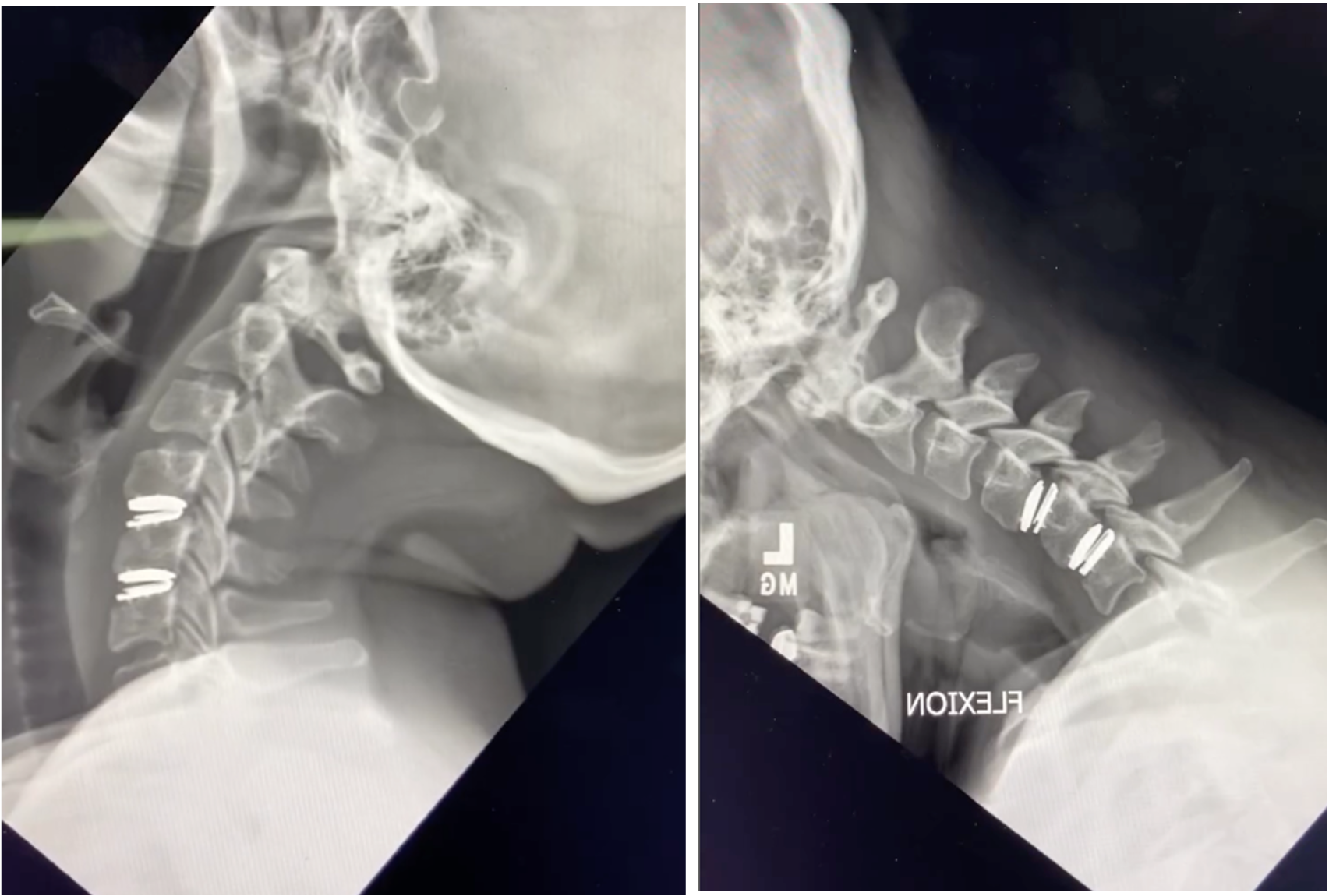 cervical disc replacement, artificial disc replacement, cervical arthroplasty, prodisc