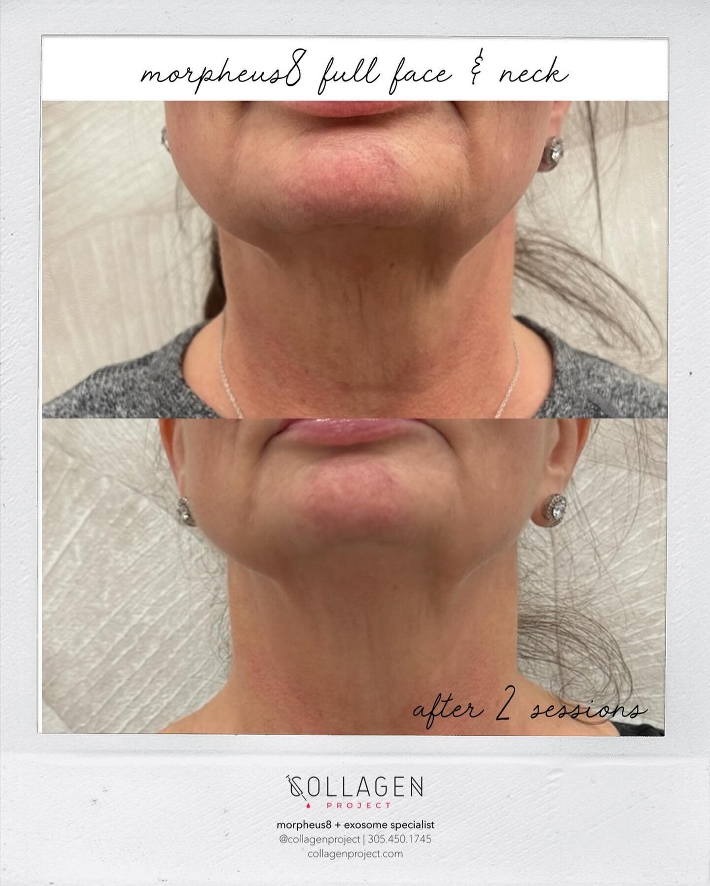 Morpheus8 full face &amp; neck ✨
Morpheus8, the revolutionary micro-needling non-surgical cosmetic treatment, can address many skin concerns, including saggy skin. Using tiny needles to create microchannels in the skin, Morpheus8 stimulates collagen 