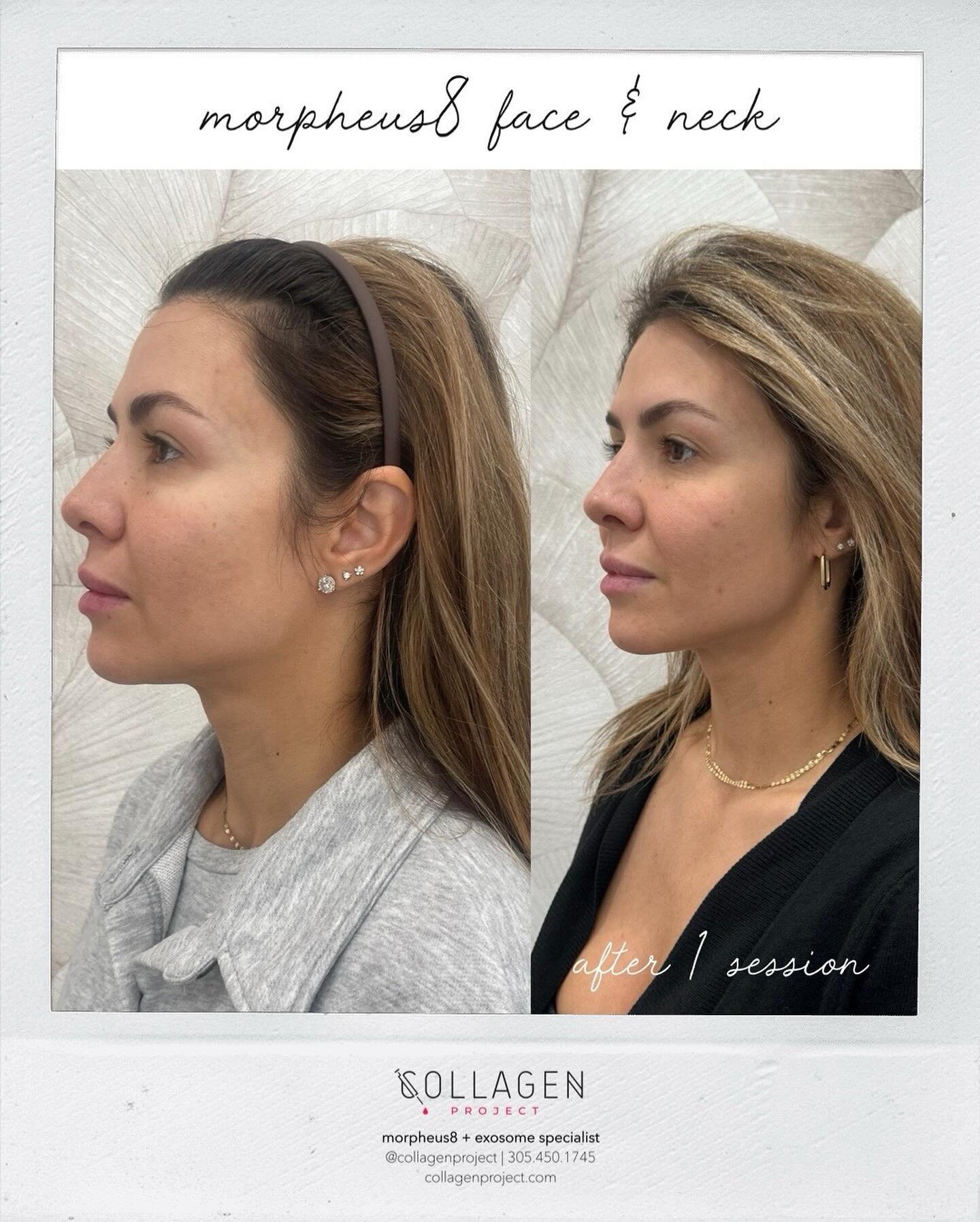 Jawline Contour 
If your jawline isn&rsquo;t snatched the way you want it to be, a few sessions of Morpheus8 can help you create those selfie profile shots you&rsquo;ve been dreaming about.
Morpheus8 helps with submental fullness remodeling (or, doub