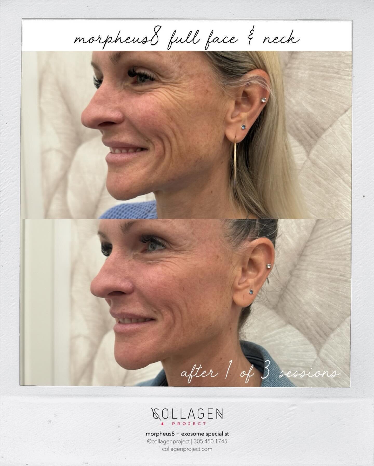 Morpheus8 full face &amp; neck after 1 of 3 sessions.
════════
morpheus8 + exosomes
❥❥❥Why We Love It
✓ Strongest and most effective non surgical skin tightness procedure available 
✓ Minimal downtime 
✓ Remodels skin tissue on a cellular level
✓ Bui