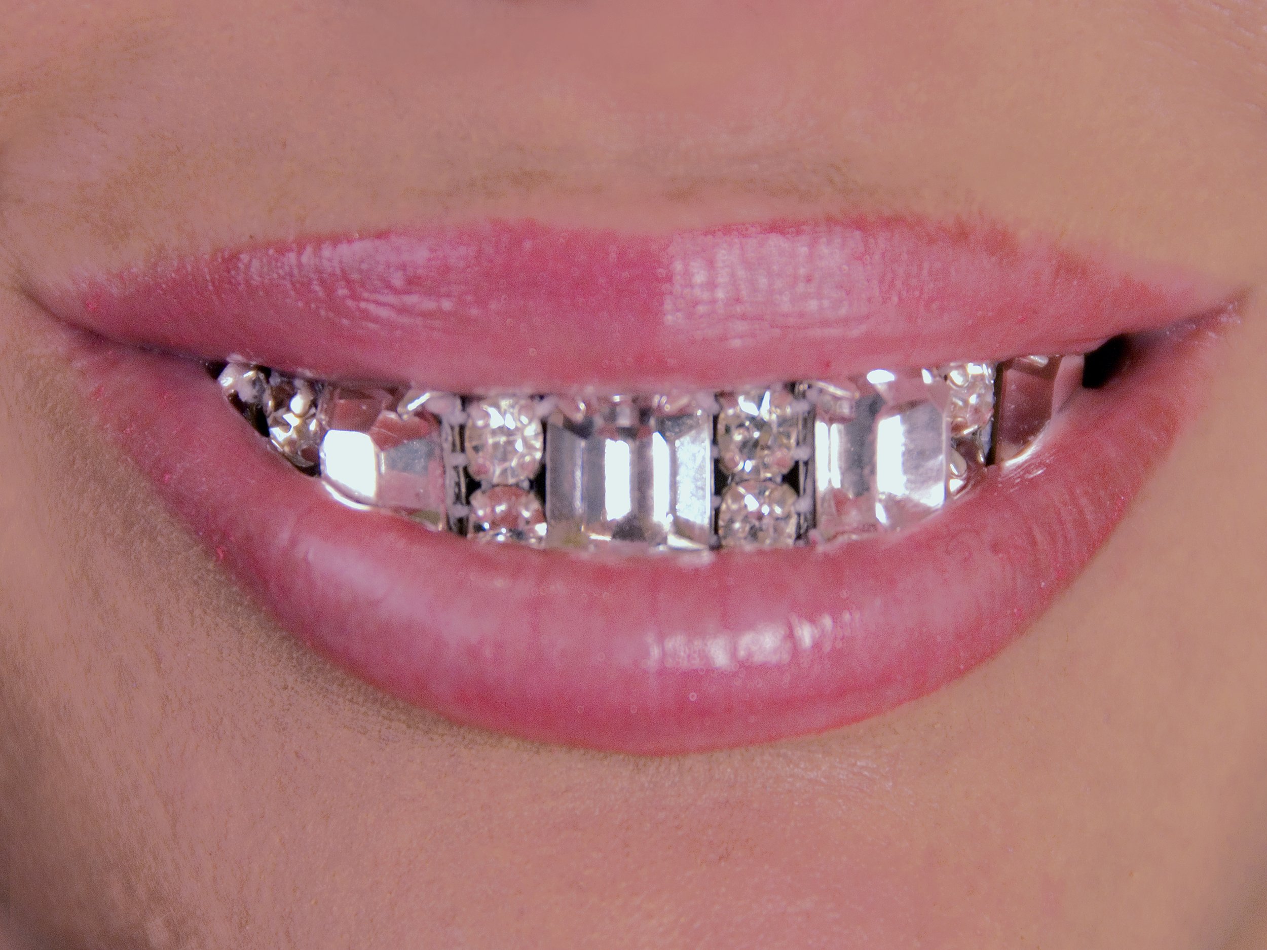old-school-braces.jpg