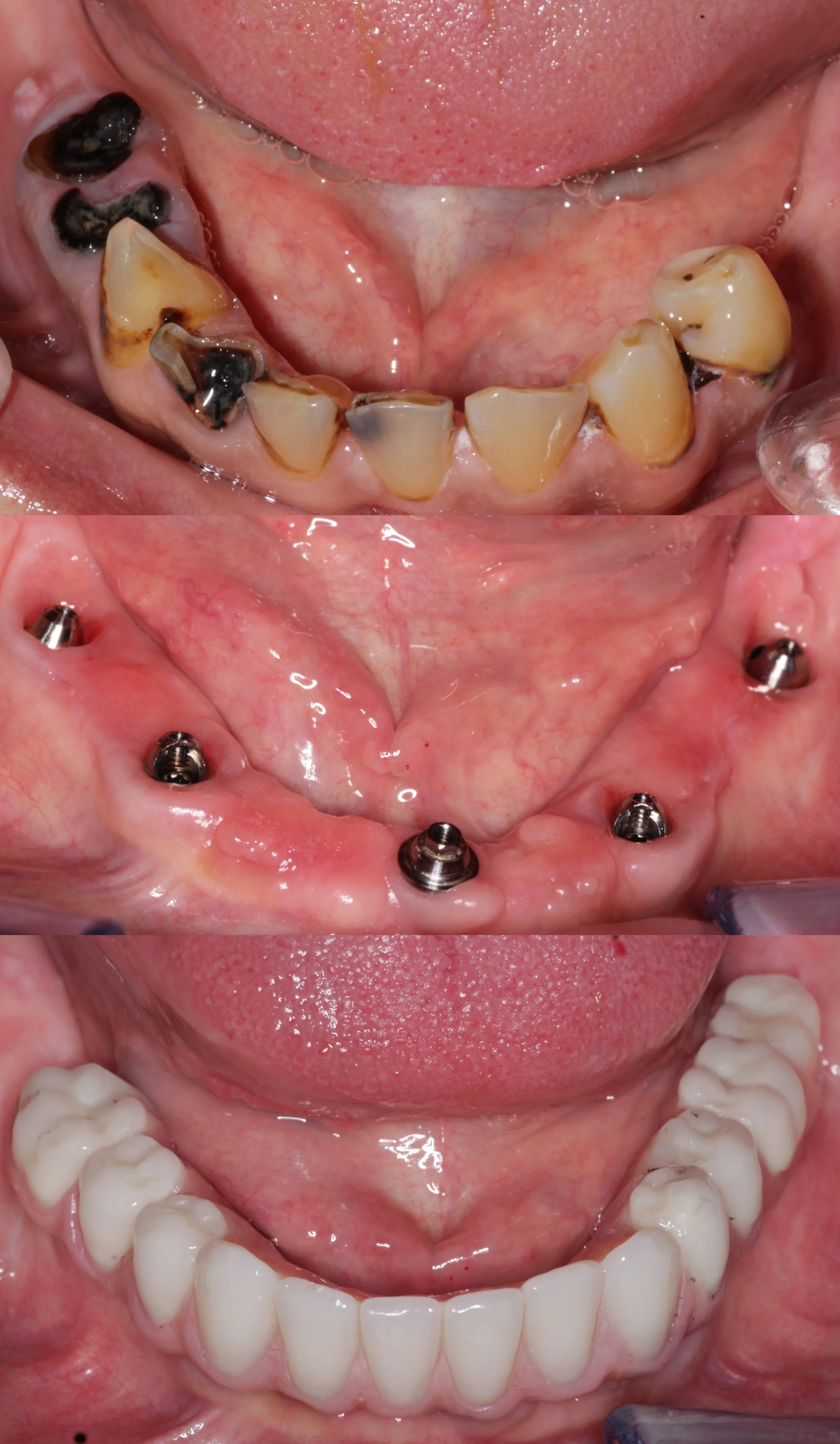 Same day All-On-5 lower w temporary teeth