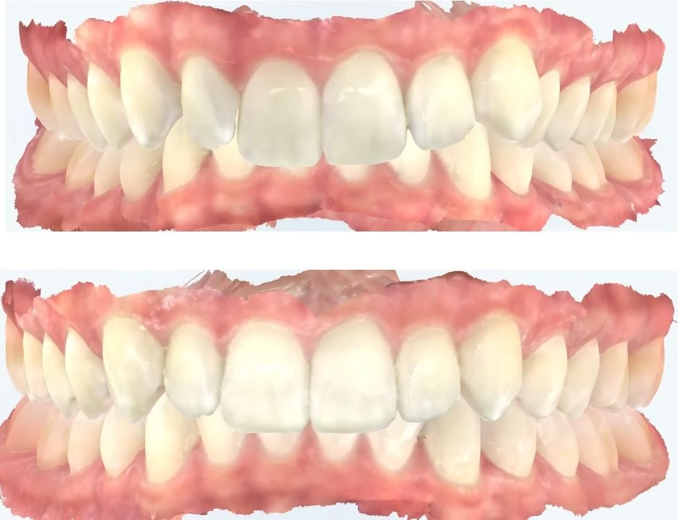 Patient 6 Before + After