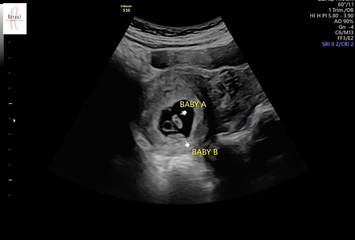 Talk about a double take at the ultrasound! 
👀😵

This mom walked in expecting to see one little heartbeat, and
 surprise, surprise&mdash;
💓💓two heartbeats were staring back at her!

Now, that's what I call a buy-one-get-one-free deal of a lifetim