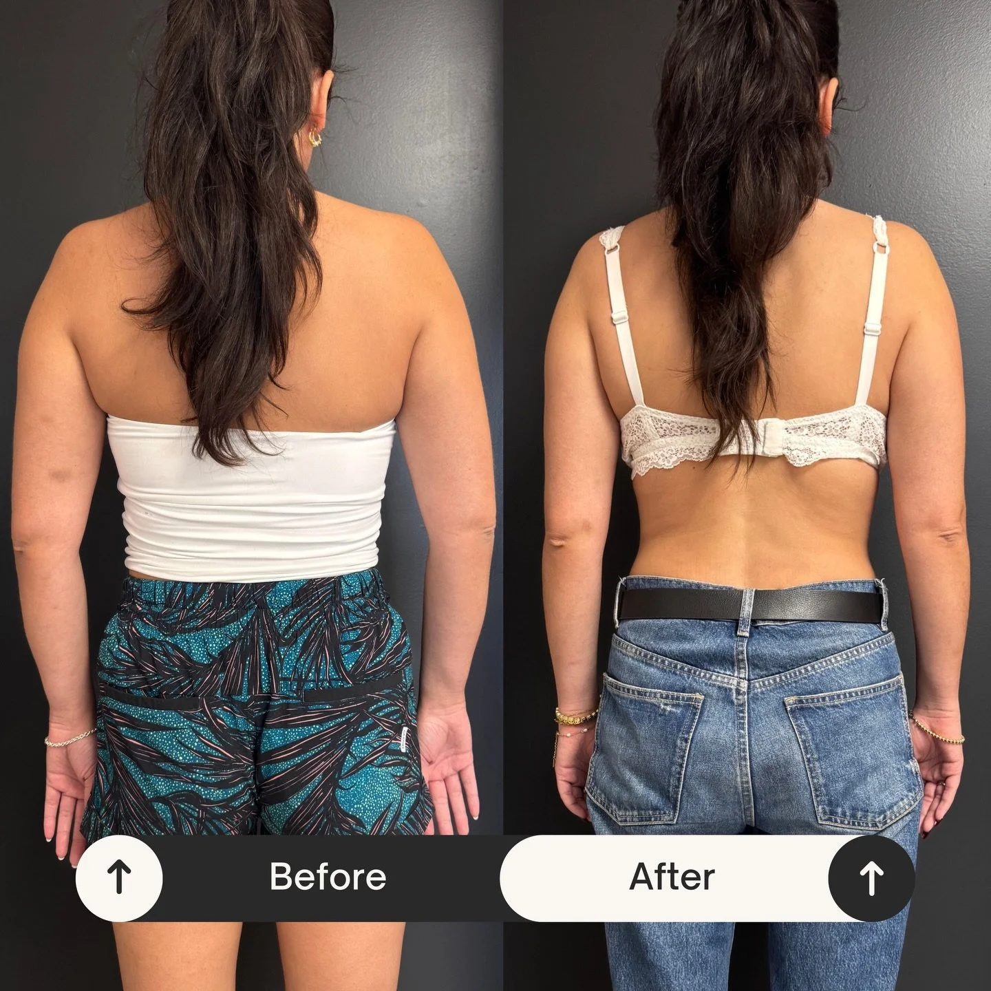 Sleeveless Confidence in One Powerful Session💪🏼 

If you avoid sleeveless tops because of your arms, this is for you. One truSculpt session heats fat cells to permanently reduce them, with zero downtime🔥