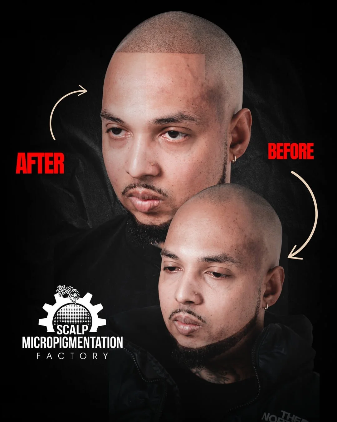Front view before and after scalp micropigmentation: a bare hairline above the forehead before, a defined straight hairline and even-looking density after.