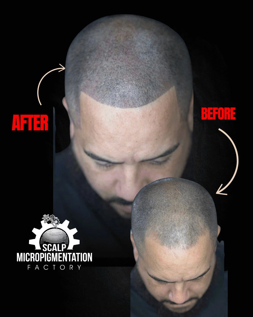 Top-down view before and after scalp micropigmentation: sparse coverage across the top before, more even-looking density and a defined hairline after.