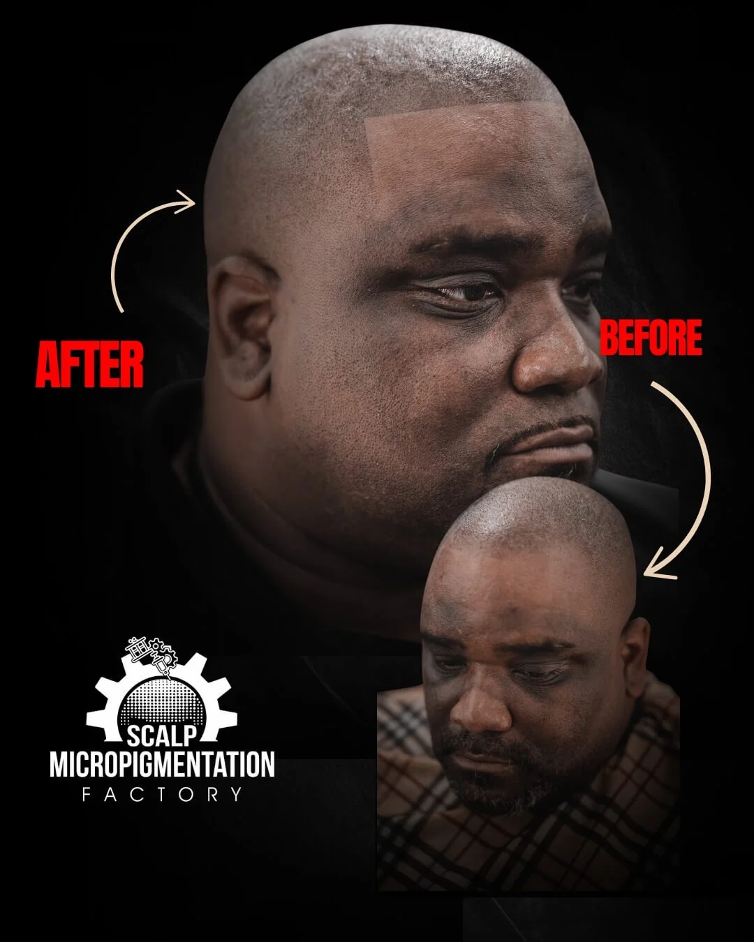 Three-quarter view before and after scalp micropigmentation: a bare scalp before, a shaped hairline and denser-looking coverage after.