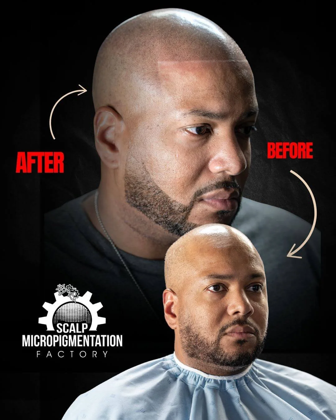 Side profile before and after scalp micropigmentation: a bare scalp before, a shaped front hairline and denser-looking temple after.