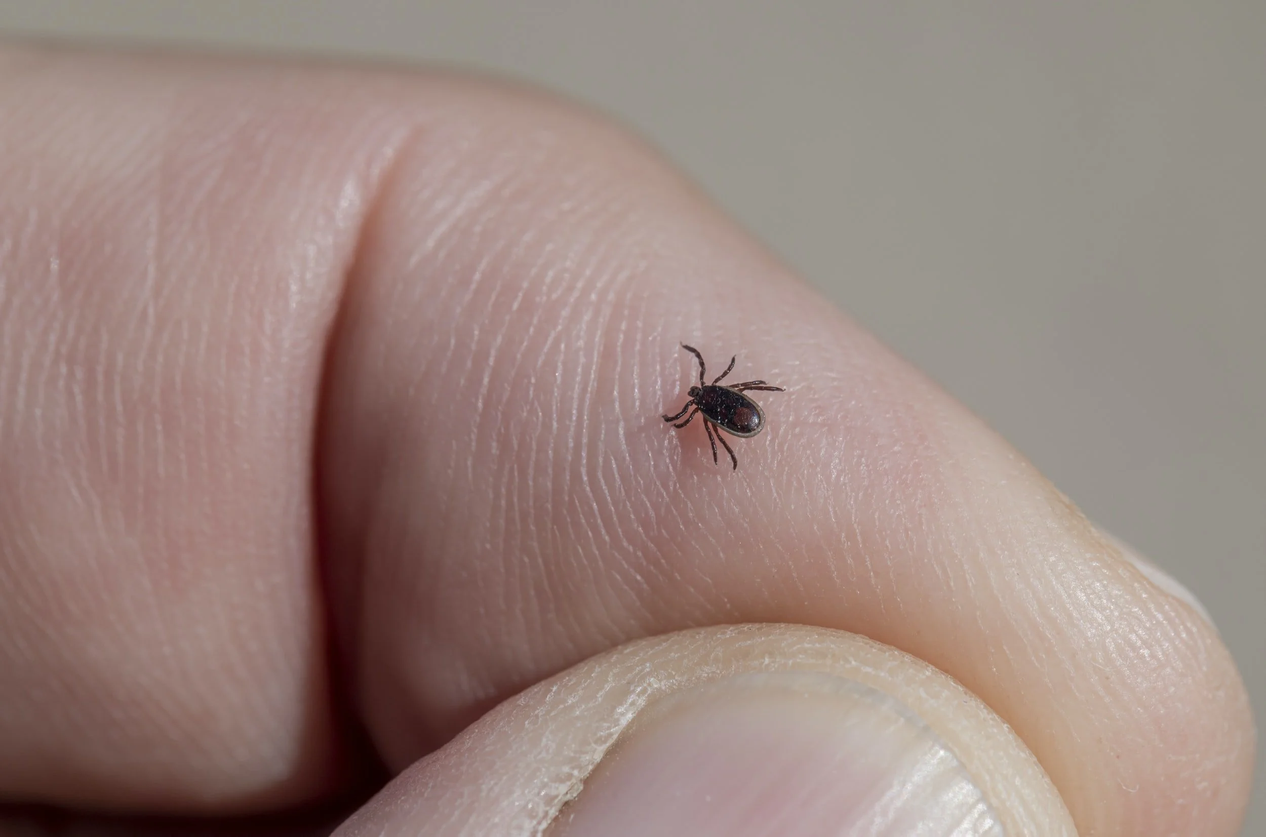 Close-up of a tick on human skin – important vector for Lyme disease and other tick-borne infections – prevention and awareness at Premier Integrative Functional Medicine in Diamond Bar California