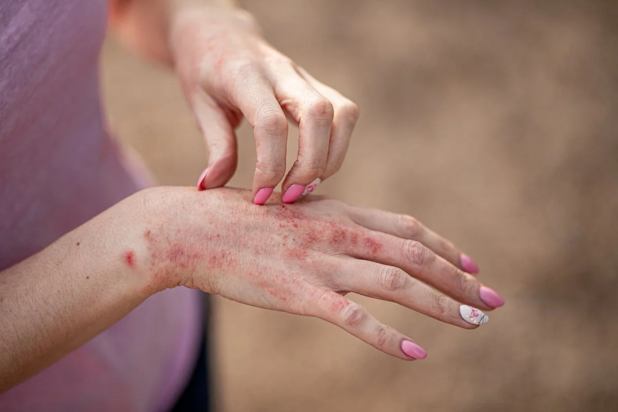 Eczema flare-up on hand, a common skin condition addressed through functional medicine and gut-skin axis healing