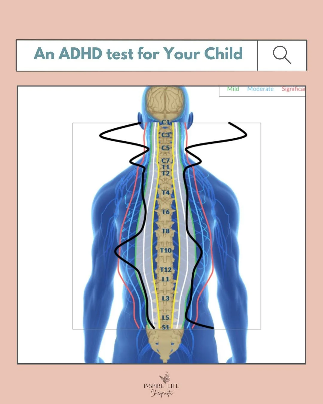 From an ADHD diagnosis to thriving!! Mom says, &ldquo;After 2 months, we started seeing his posture change. His balance and confidence in Karate were improving. Even his mood was changing for the better.
Now, he sleeps better at night, especially on 