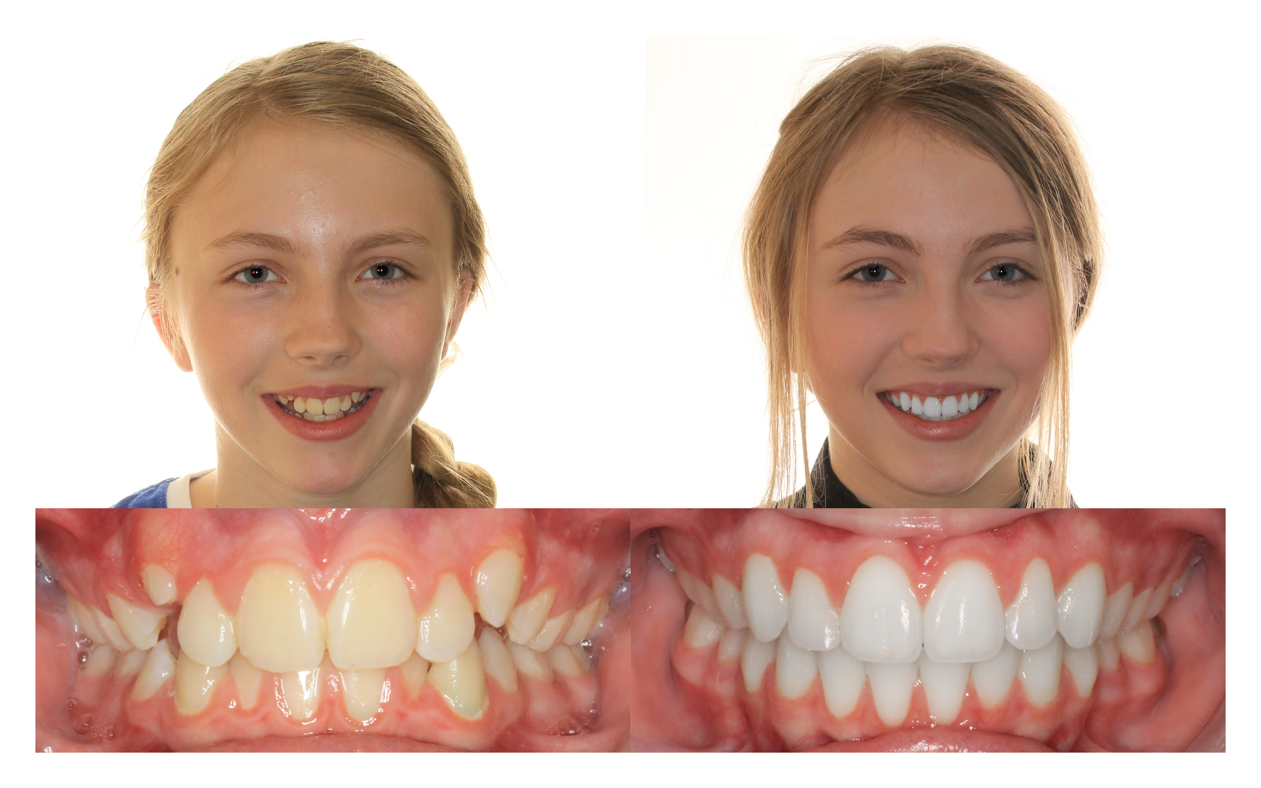 Before orthodontic treatment at Hohl Orthodontics and After