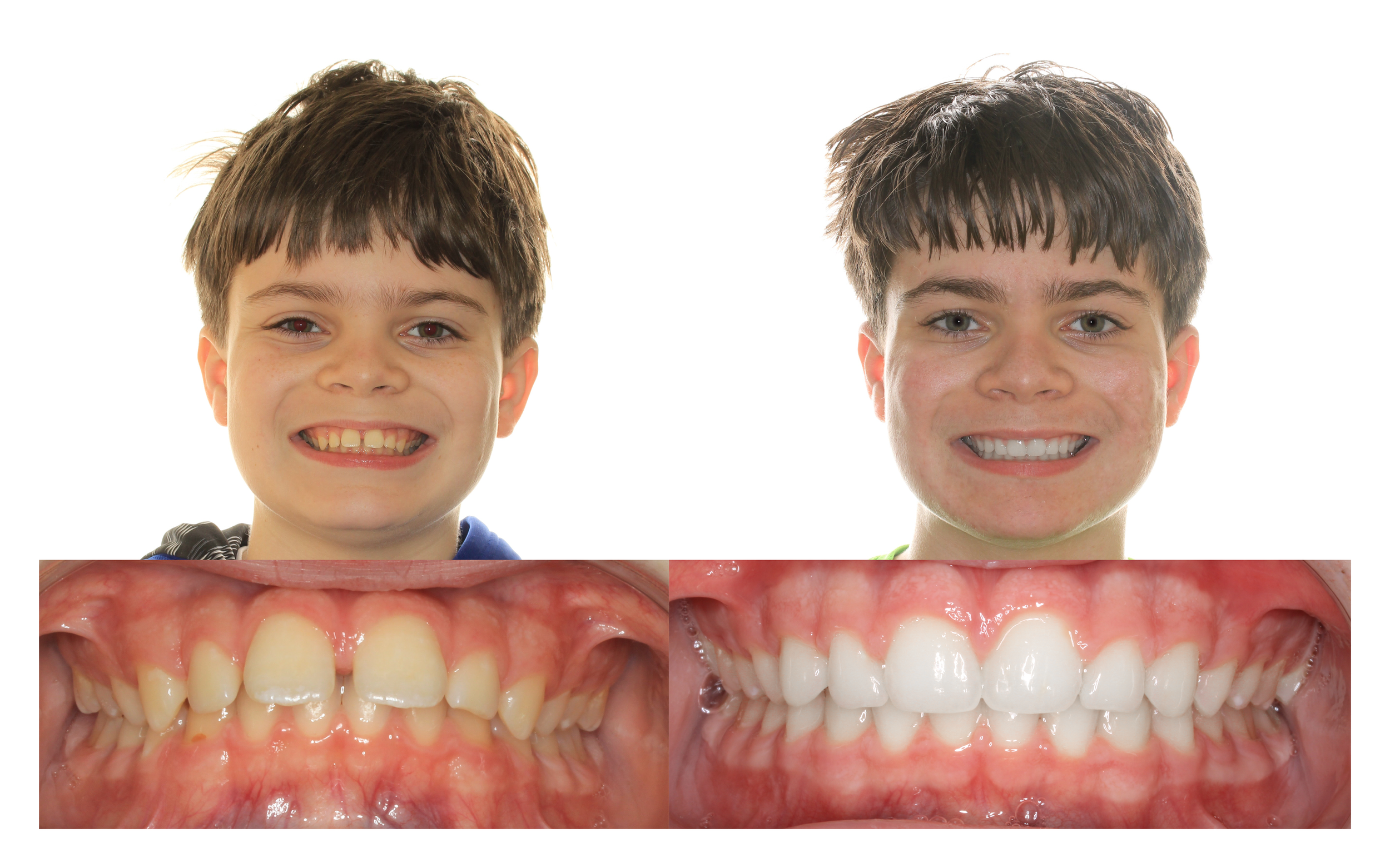 Before orthodontic treatment at Hohl Orthodontics and After