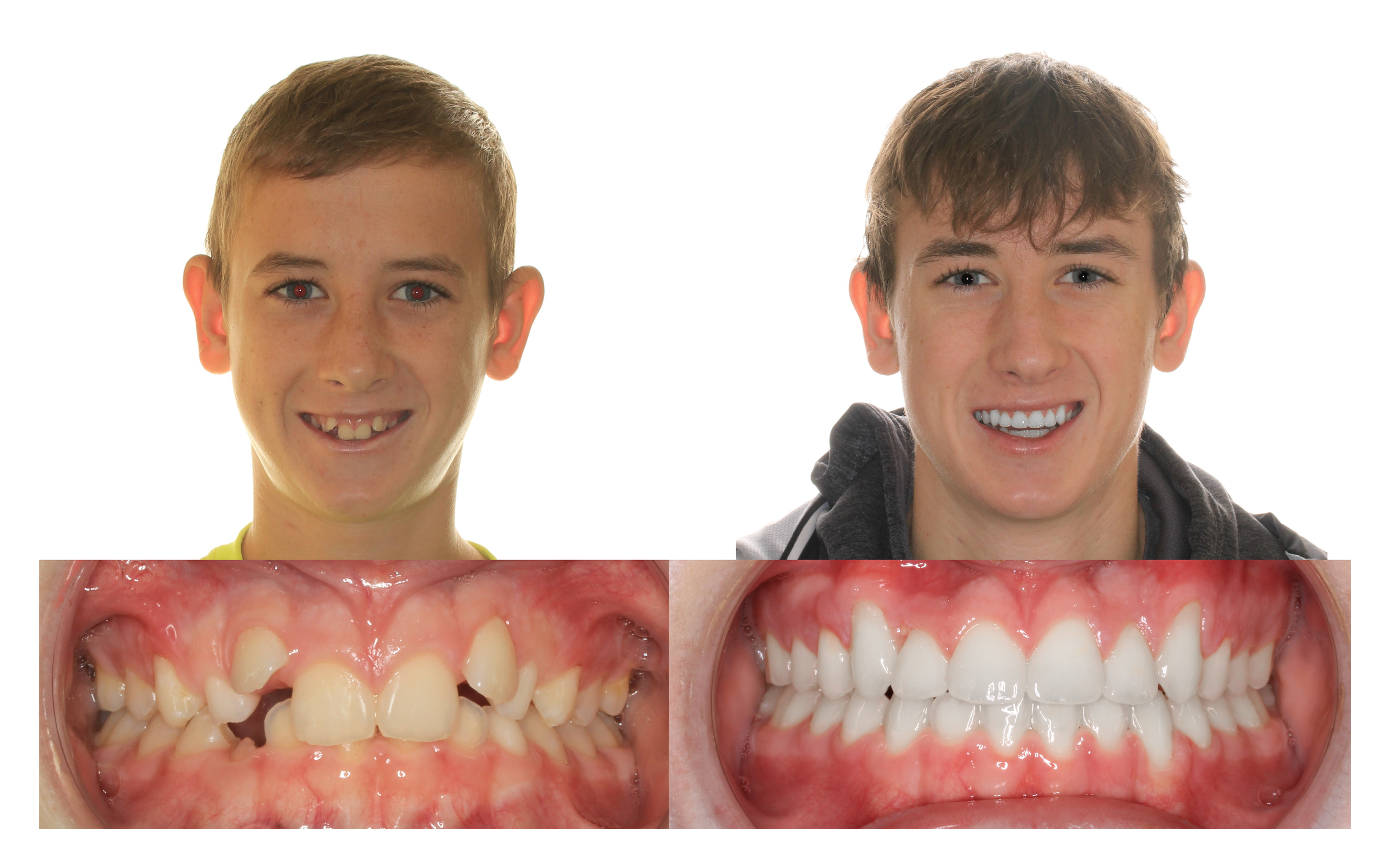 Before orthodontic treatment at Hohl Orthodontics and After