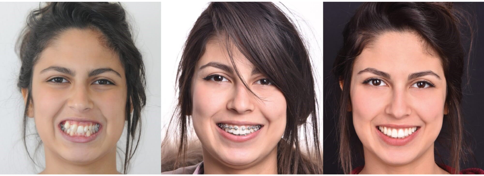 Crowding before and after orthodontics without extractions