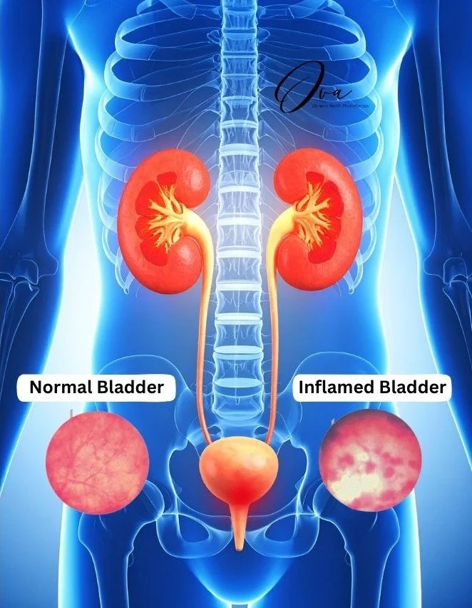 Interstitial Cystitis/Painful Bladder Syndrome — Ova Women's Health Clinic