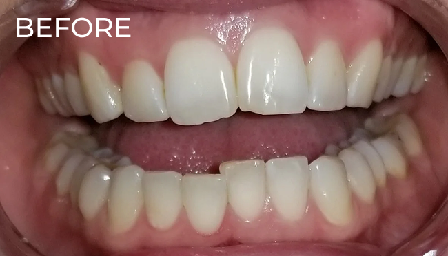 Before professional teeth whitening treatment showing natural tooth shade.