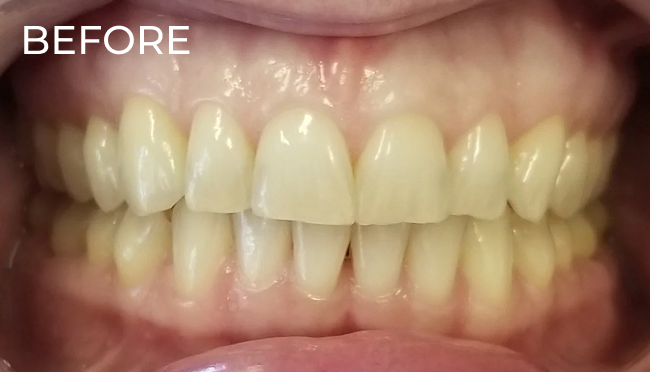 Teeth prior to cosmetic whitening treatment.