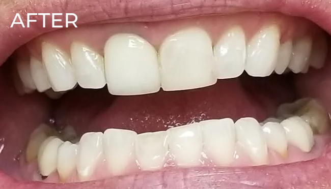 Patient smile after in-office teeth whitening with enhanced brightness and a more even tooth tone.