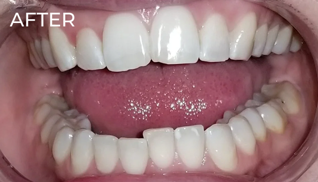 After professional teeth whitening treatment showing noticeably brighter, whiter teeth.