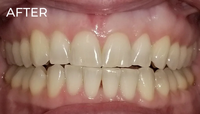 Teeth following cosmetic whitening treatment with visibly whiter enamel and improved smile appearance.