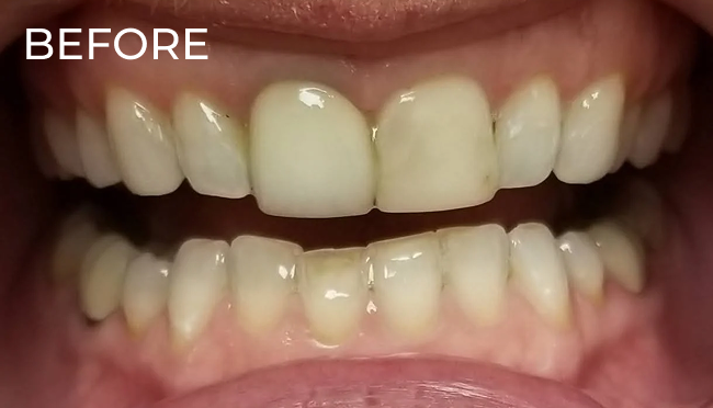 Patient smile before in-office teeth whitening with mild surface discoloration.
