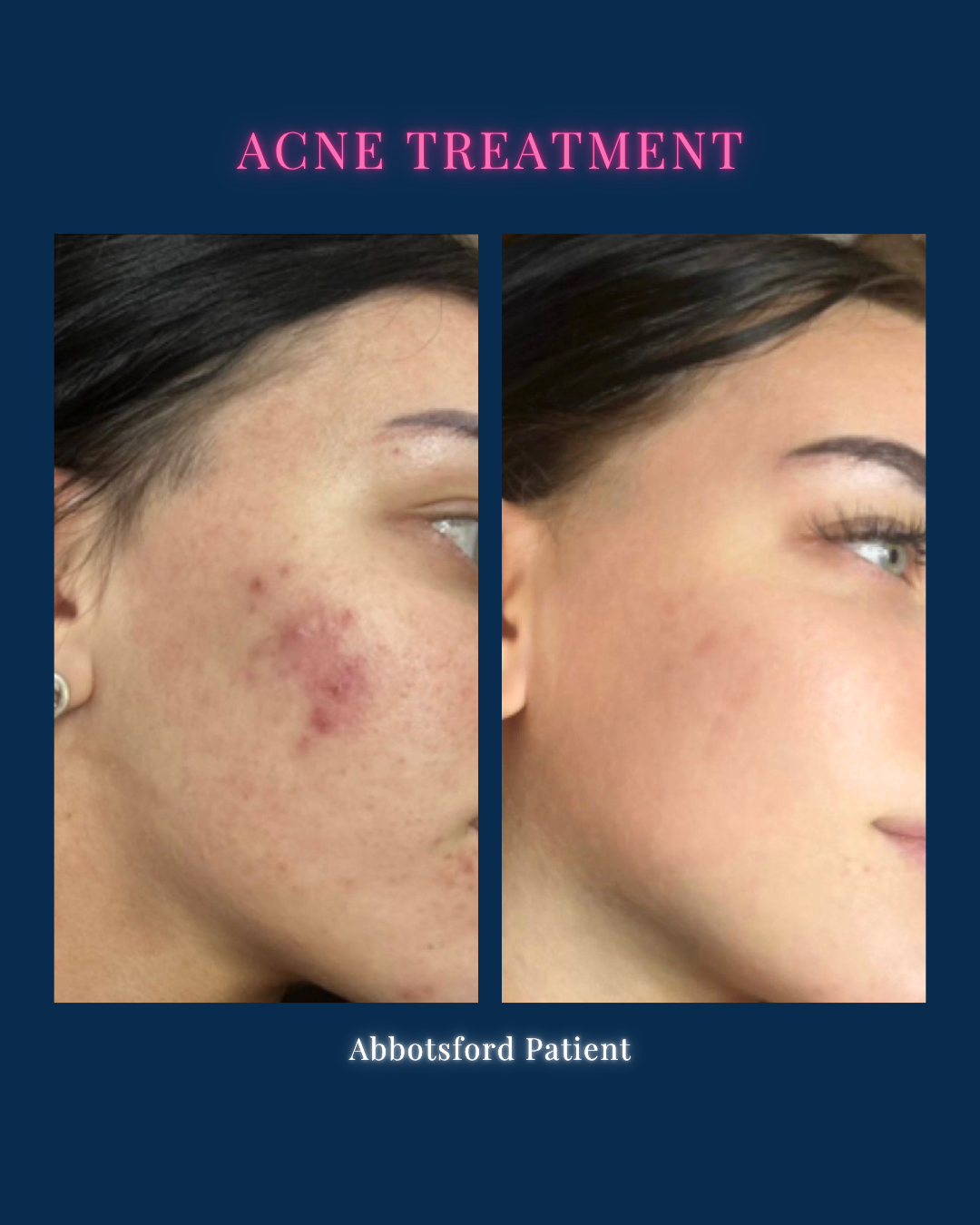 A Guide to Acne Scar Treatments: Morpheus8, PRF, Plexr and More