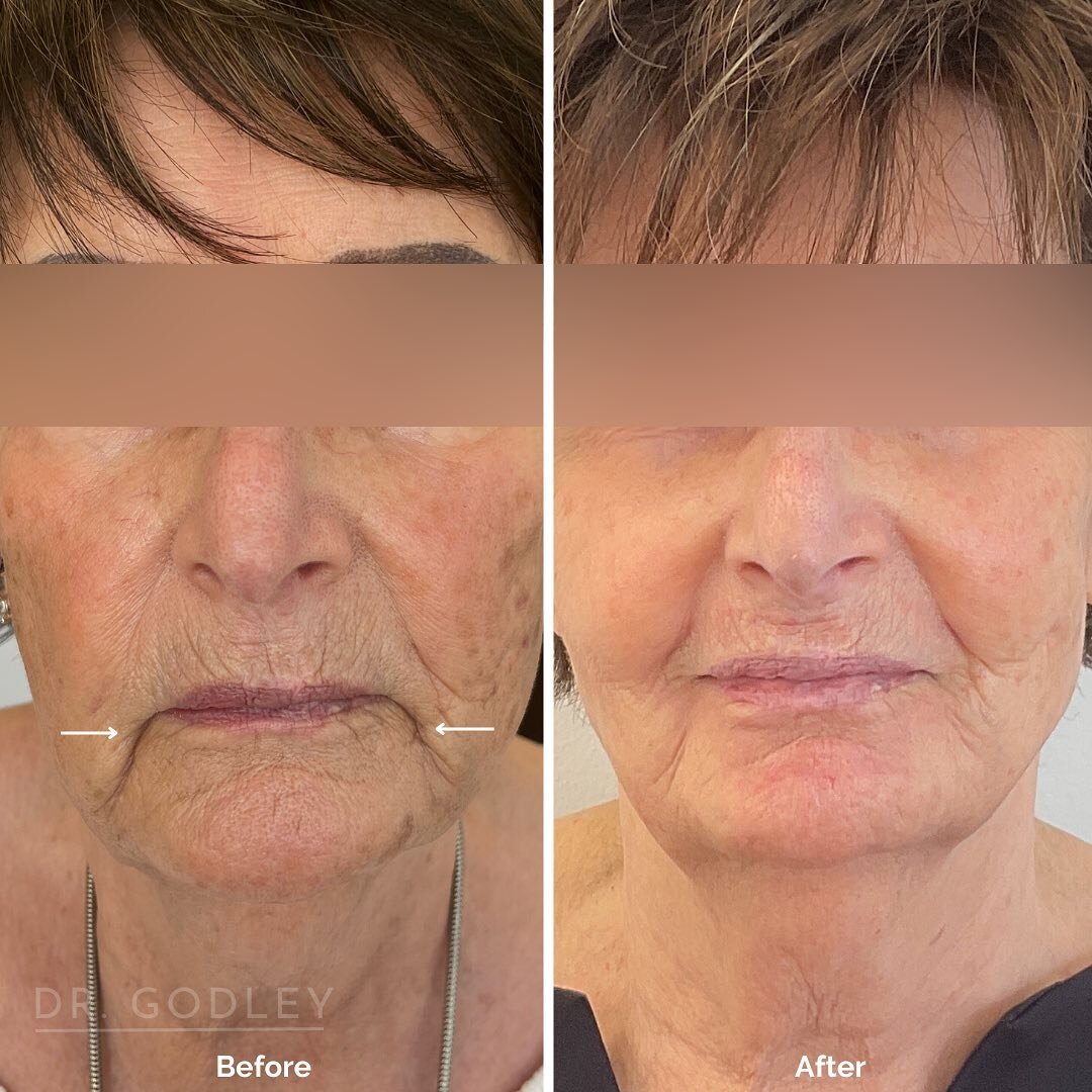 ✨ Today's Before and After: Morpheus8 and Plexr treatments to the lower face to reduce deep lines.

Want her results? 😍✨ Book your consult today

📲 (778) 222-0232 Vancouver
📲 (604) 779-0060 Abbotsford

#medicalaesthetics #doctor #aestheticdoctor #