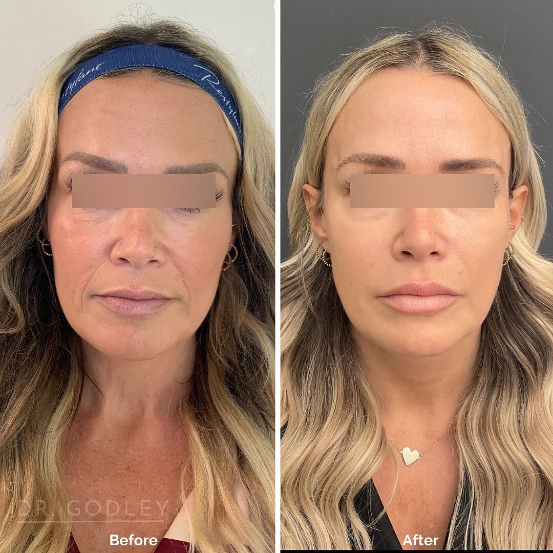 ✨ Today's Before and After: Radiesse filler in her cheeks and temples to experience an instant glow, reduced wrinkles, and restored volume. 

Radiesse is not an ordinary dermal filler, it's also an anti-aging skin stimulant! Want her results? 😍✨ Boo