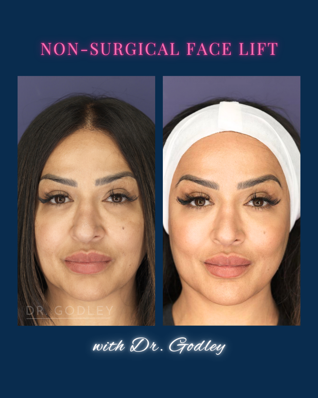 Before and after thread lift