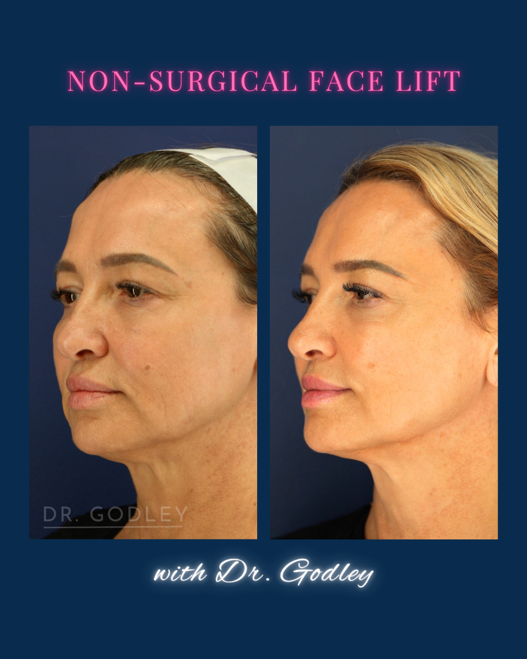 Before and after thread lift 
