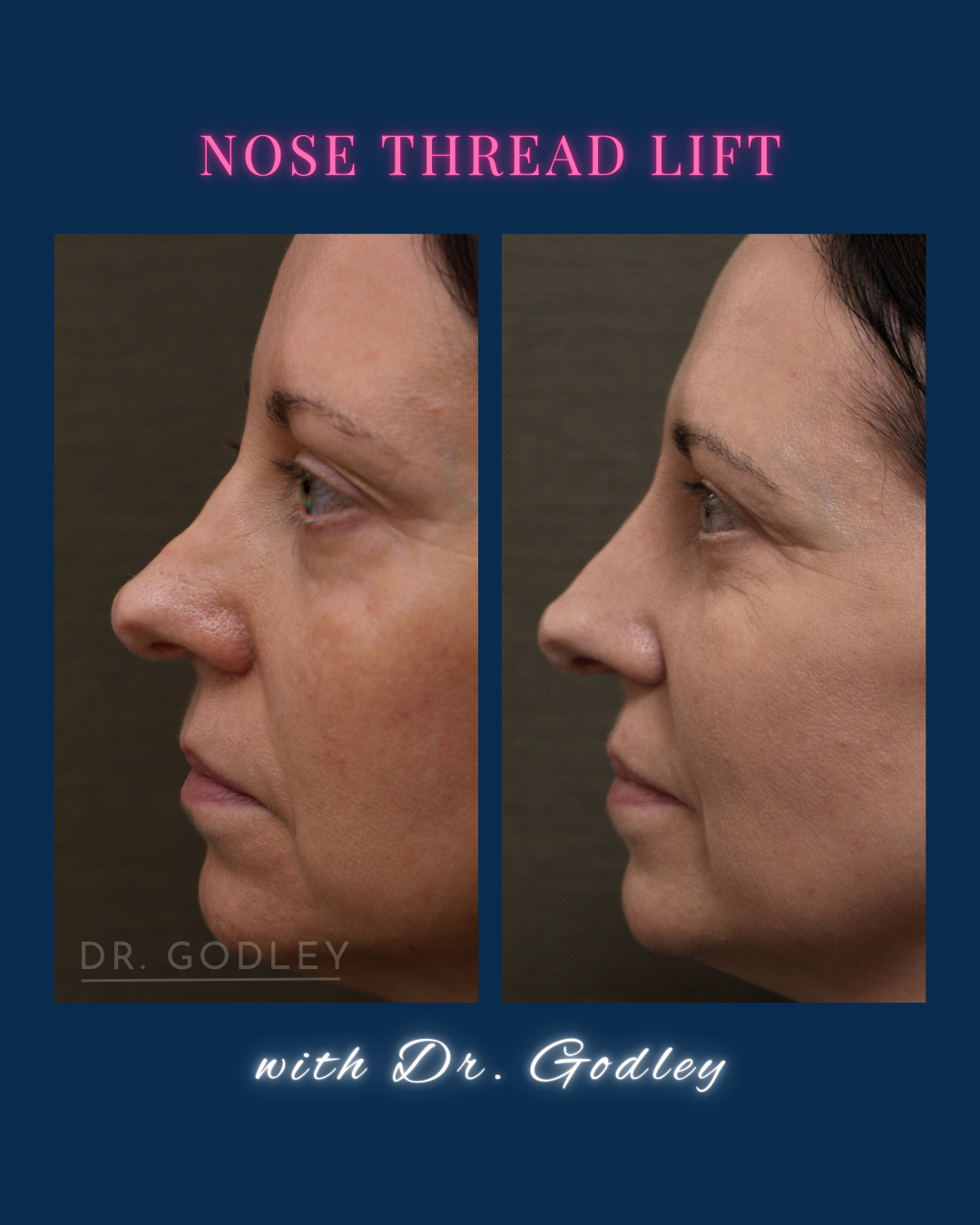 Nose thread lift before and after