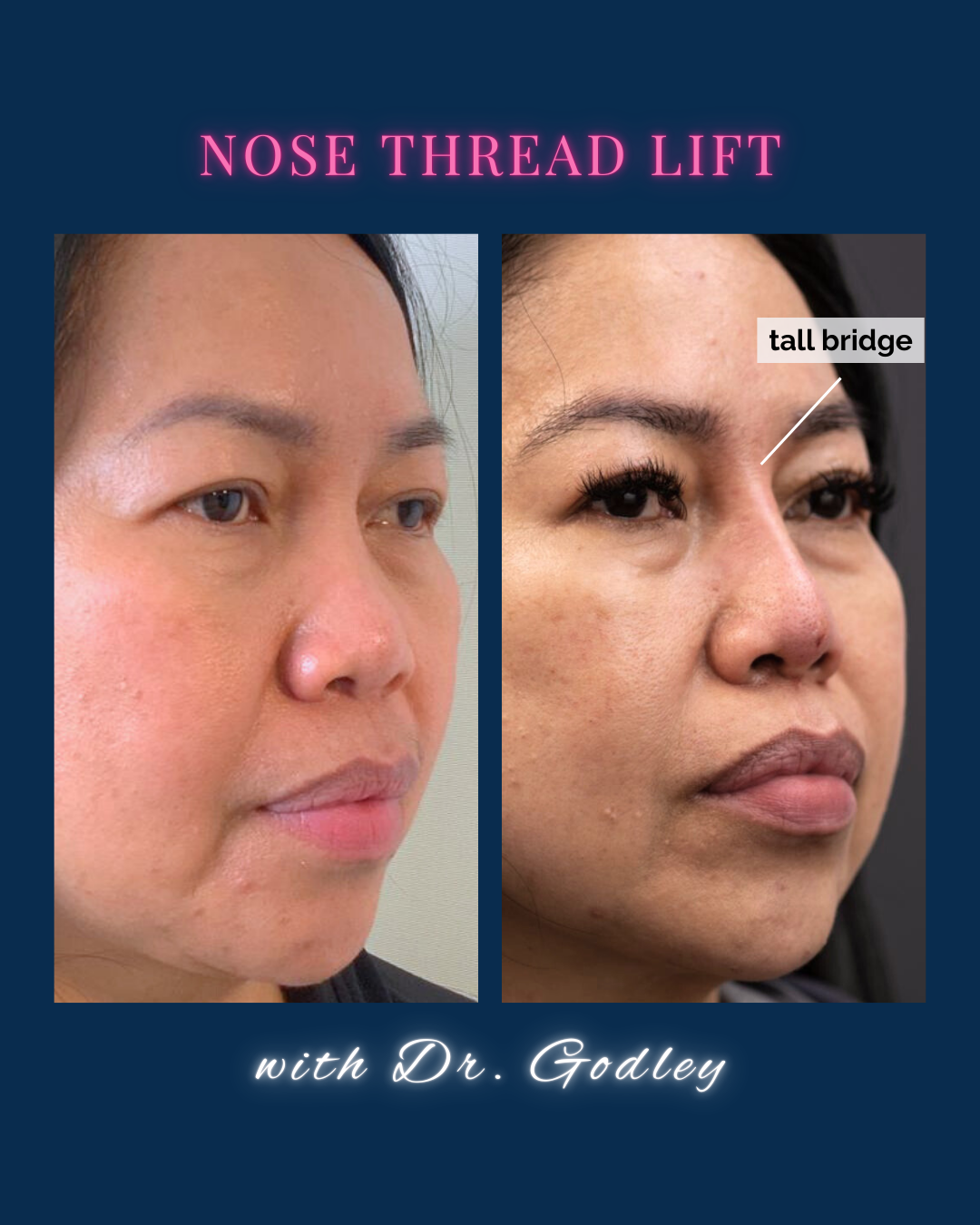 Nose thread lift before and after
