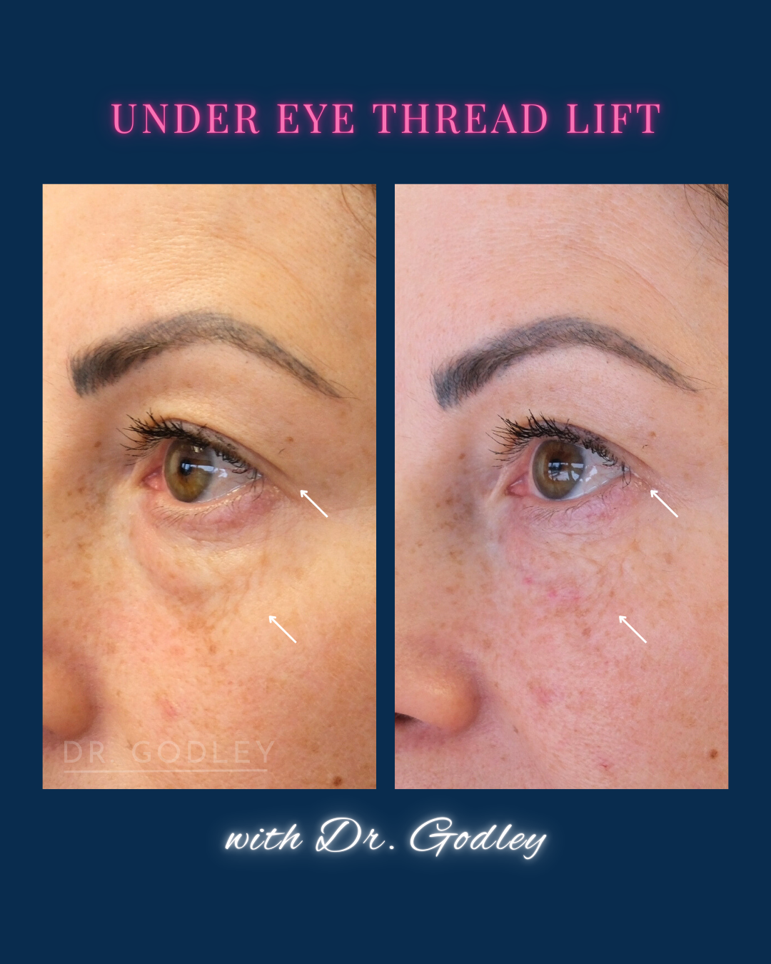 Under eye thread lift before and after