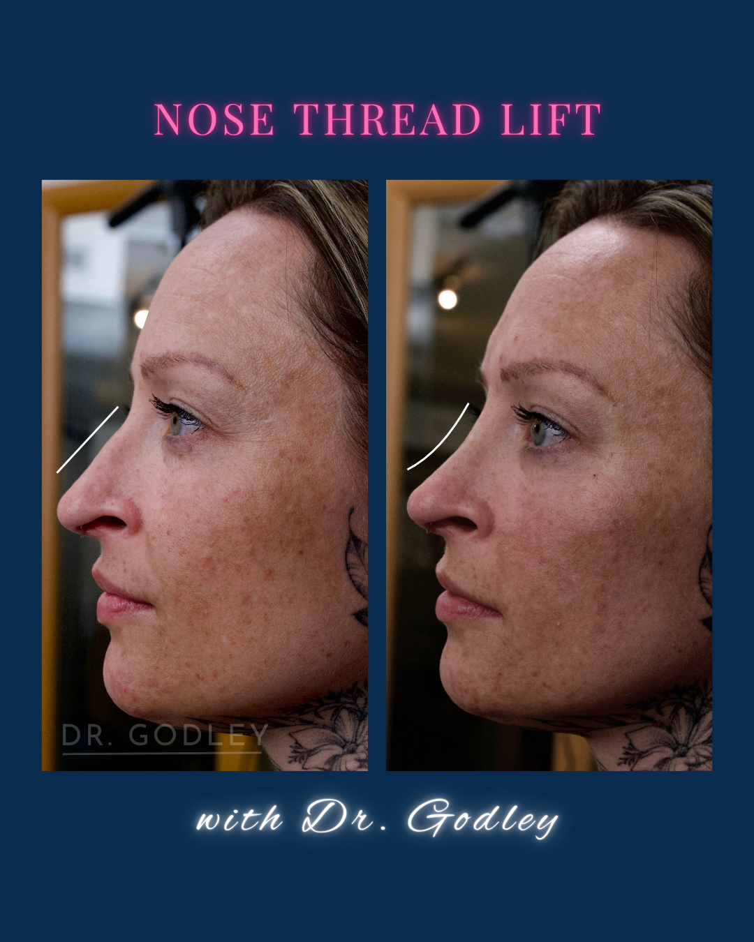 Nose thread lift