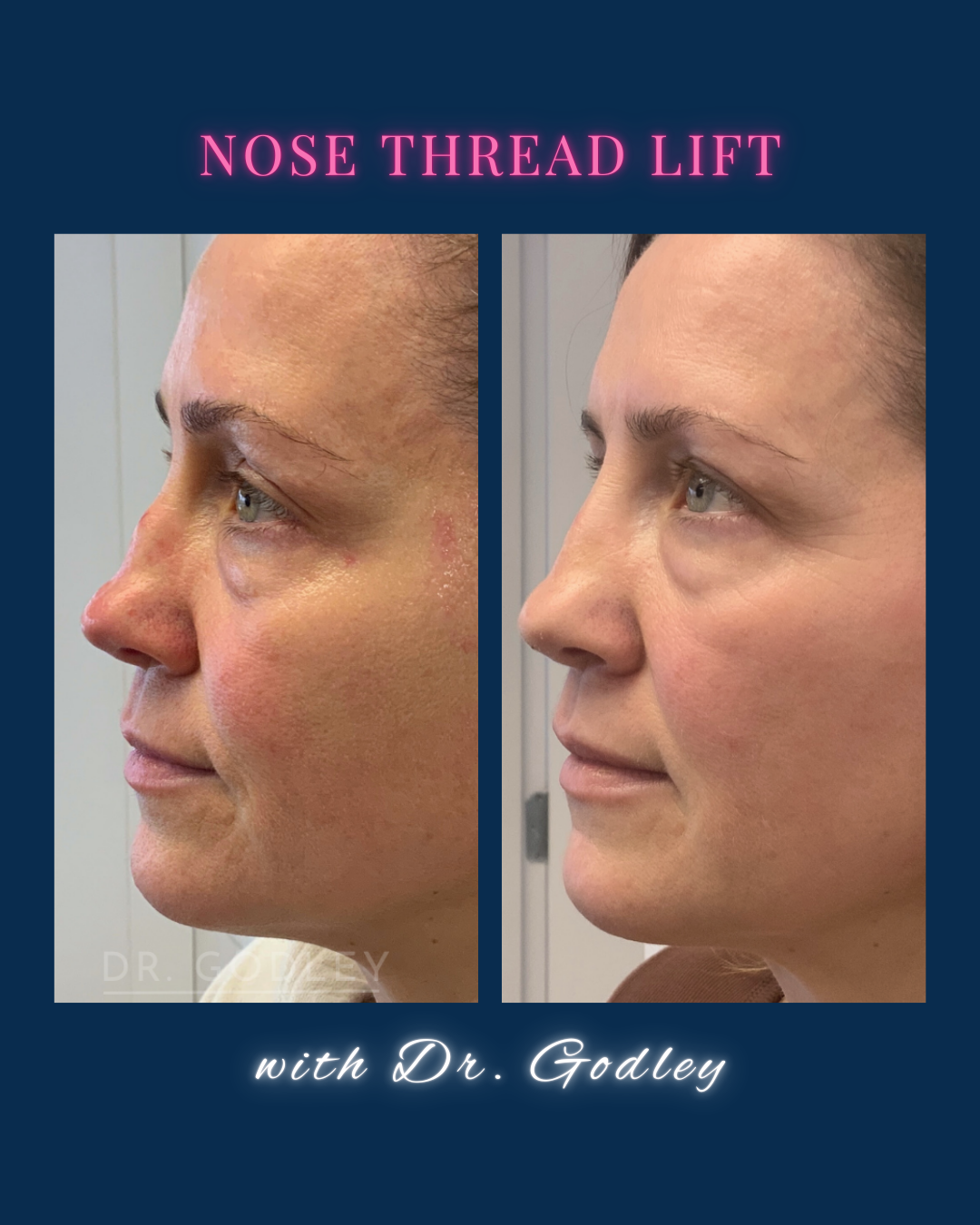Nose thread lift