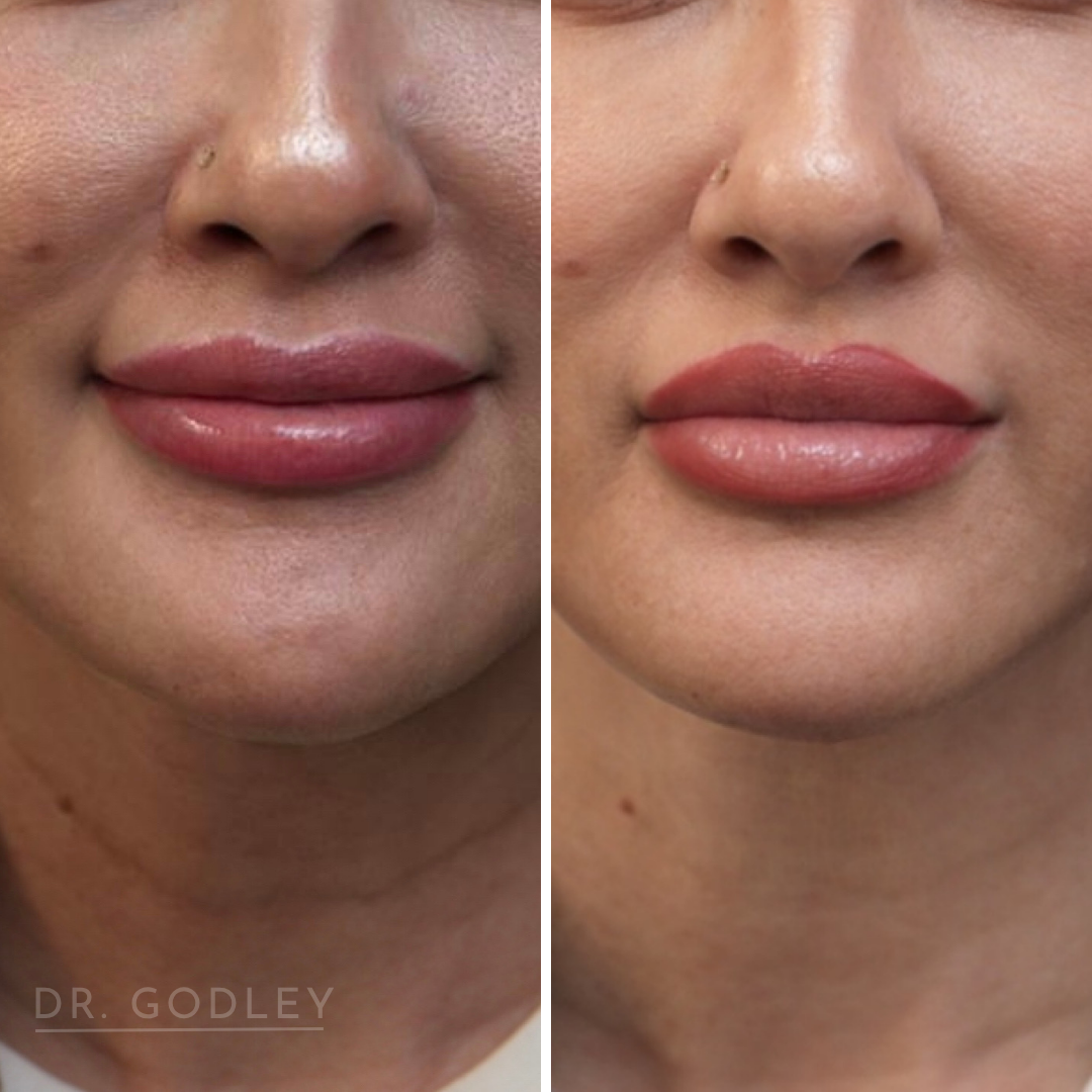 Sculptra neck treatment with mono thread lift