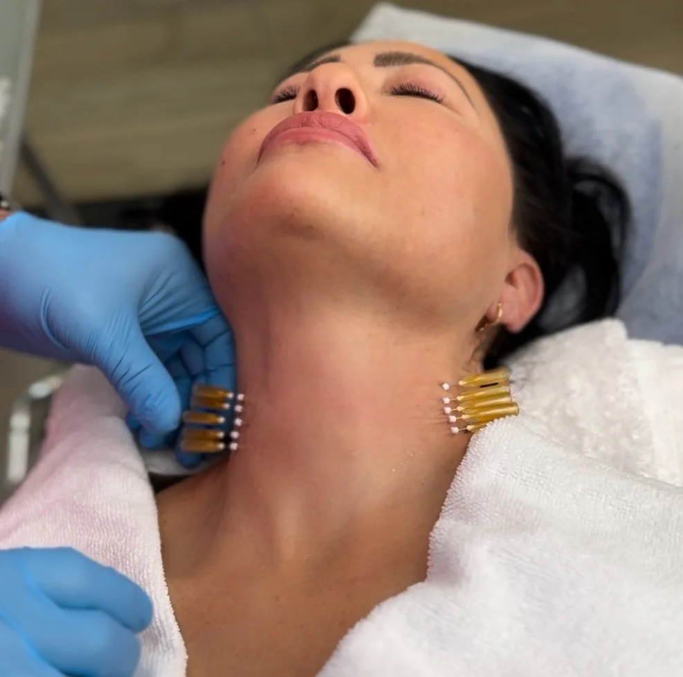 Before You Book a Facelift, Learn About Thread Lift for Jowls